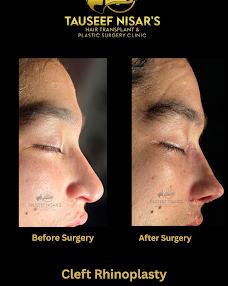 Cleft Rhinoplasty — after